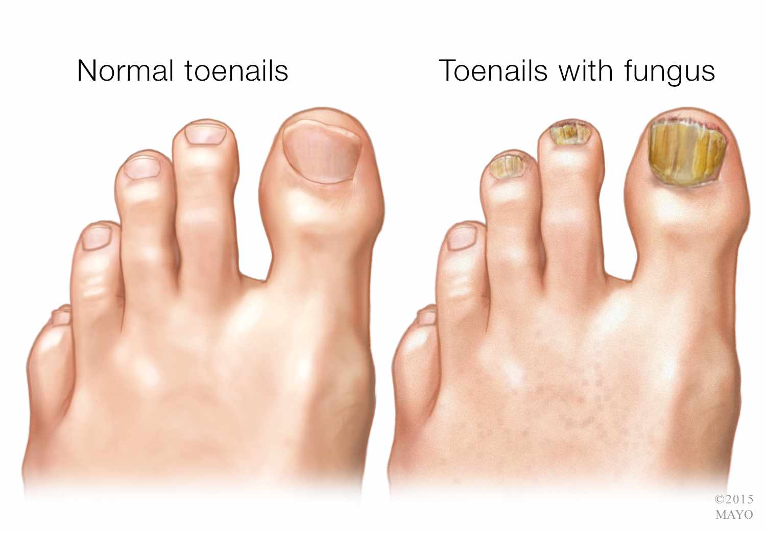 Toenail Fungus Thickened And Yellowing Nails Premier Medical Group